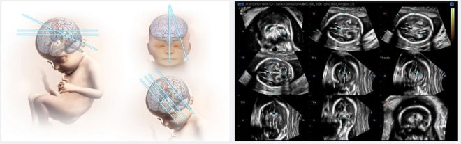Беременность большая голова. Гидроцефалия нейросонография. Нейросонография головного мозга опухоль. Сонография головного мозга новорожденных. Микроцефалия у плода на УЗИ.