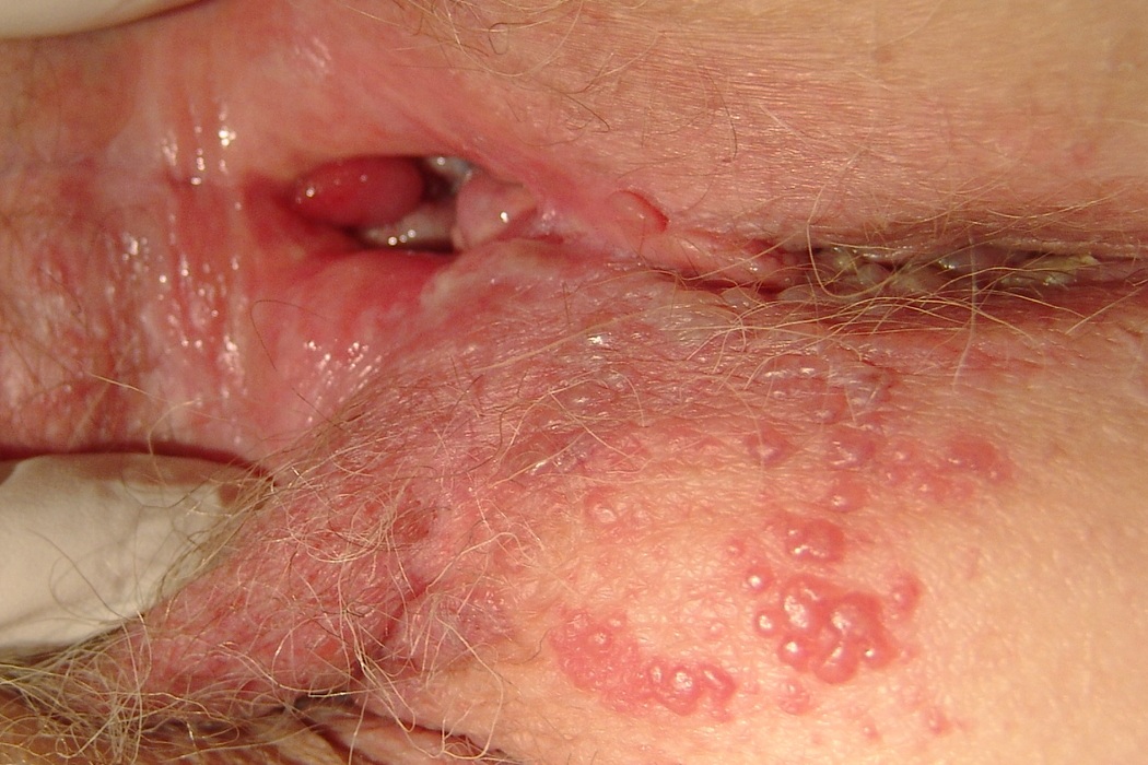 Herpes en la nariz